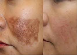 Papaya Soap For Pigmentation 100g