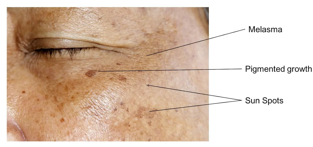 Anti-Pigmentation Cream - Even Skin Tone, Treats Hyperpigmentation