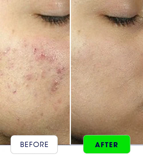 MandelAC Serum / Reduces Pimples | Even Skin Ton 20Ml